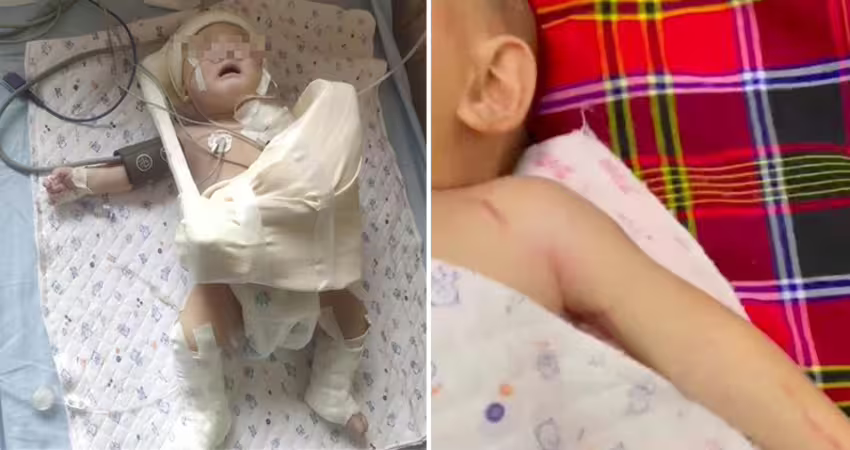 難產「扯斷男嬰手臂」媽崩潰　醫：不拉斷出不來