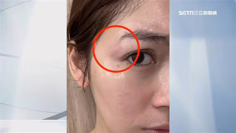 非首次出包？女星遭200度電棒捲燙傷臉　髮廊負評驚見「剪到耳朵流血」