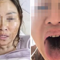 中國又出現新病毒？確診者「臉、舌燒焦」毀容　身體狂冒煙
