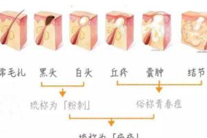 粉刺、黑頭的處理方法