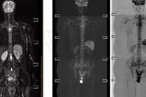 被稱為「查癌神器」的全身類PET磁共振成像，你了解嗎？