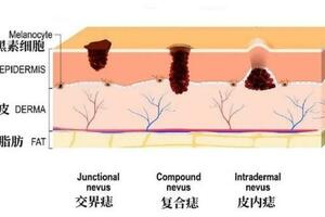 普通痣和黑色素瘤，如何科學辨別