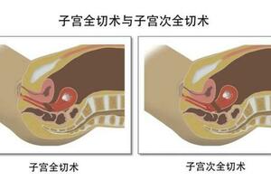 子宮切除的利弊是什麼？