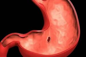 胃潰瘍的成因和可能的併發症 胃潰瘍是一種常見的胃部...