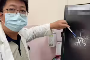 高溫勞動突倒地 「暫時性腦缺血」險釀中風