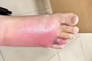 沙發睡一覺　男子腳掌竟變超腫！險截肢原因曝