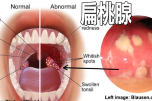  「扁桃腺」反覆發炎看不好？多喝三種天然飲料，活化細胞遠離咽喉疼痛。