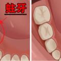 靠刷牙並不能100%預防蛀牙！學會5種預防、治療蛀牙的秘方，維護口腔健康。