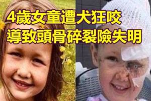 4歲女童遭犬狂咬到導致頭骨碎裂險失明