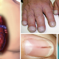  心臟病、肝硬化、肺腺癌「指甲」透端倪：趕緊自我檢測，「7種異常外觀」須警覺！