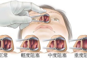 以前都不知道…原來鼻塞可以這麼簡單解決！痛苦的日子終於要結束了，學起來就可以暢快呼吸！