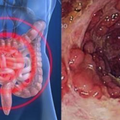 莫名拉肚子的人千萬注意！這種「排便形狀」是腸癌的高危險徵兆！超過這個年齡的人更要提高200%警覺！