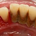 牙周病並非突然到來，提醒：口內出現5種小病要警惕
