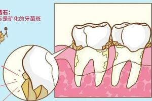 勸人洗牙是「消費套路」嗎？