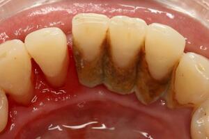 牙周病並非突然到來，提醒：口內出現5種小病要警惕