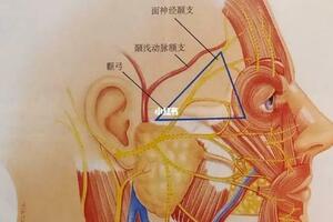 注射異物專場：太陽穴注射異物取出，很多醫生不敢做取出？