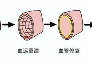 除了心臟支架植入，還有哪些新的介入技術？