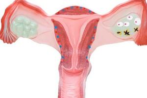 卵巢癌的症狀有哪些？出現這5種症狀要提高警惕