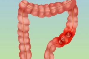 別把腸息肉拖成腸癌，醫生忠告：腸內長息肉時，身體或有5種異常