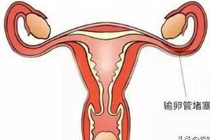 ​輸卵管堵塞的症狀與宮外孕的警示：理解生殖健康的兩大關鍵