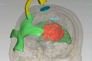 3D列印術，讓腦外科醫生精準動刀