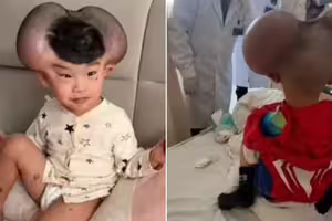 3歲童罹罕病頭上長巨痣　手術成功他終於笑了