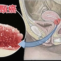 「子宮頸癌」有救了！這個我們「常吃的菜」竟可殺死多它100倍的子宮頸癌細胞！！一定要分享出去！