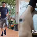 男子自學艾灸　33天後「雙腿驚現黑洞」仍不停