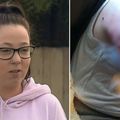 20歲澳女被2惡犬攻擊　狂咬30下縫60針狗主拒絕道歉