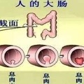 大腸癌發現時已是晚期，哪些癥狀暗示「大腸癌」？如果突然出現「四個癥狀」要注意，最好去醫院做檢查