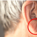 快檢查耳朵！這個位置有褶痕 可能是心肌梗塞的徵兆