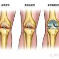 3種膝關節置換手術比一比