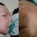 3月嬰遭父狠打　雙頰都是紅腫巴掌印
