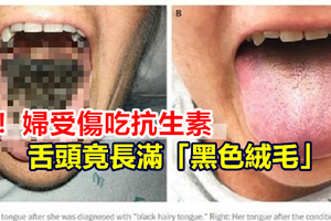 驚！婦受傷吃抗生素 舌頭竟長滿「黑色絨毛」