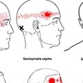 5種「經常被輕忽但不立即就醫其實能致命」的頭痛癥兆。睡覺醒來頭痛原來這麼嚴重！