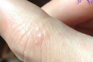 很多人都沒發現！！「手指」突然長出這種小水泡…竟是大病前兆！千萬要小心了…