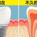 成年也能換牙！　科學家發現「自體長牙新技術」比植牙還便宜