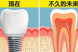 成年也能換牙！　科學家發現「自體長牙新技術」比植牙還便宜