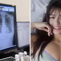 寫真偶像炫耀「我的肺很乾淨！」　網看X光全歪樓：太刺激了