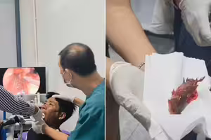 活魚卡在喉嚨裡　男緊急送醫慘了