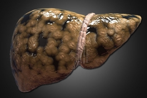 為何「肝癌」一發現就是晚期？你的肝若出現這三種症狀，就恐怖了...千萬要注意！！