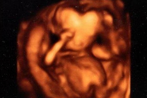 懷孕16周時，照出胎兒頭部竟是「心形」！！堅持不墮胎生下後，寶寶的頭竟然…