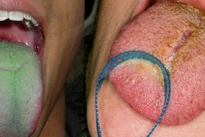 刷牙時到底該不該「刷舌苔」90%的人都弄錯了！你的「舌像」變這樣要趕快就醫！太可怕了....