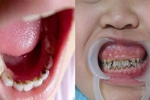 不到兩歲就滿口「黑牙」，醫生提出警告．．．再不改正「這些行為」，連新長出來的牙齒都會是黑的