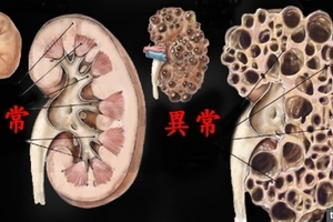 醫生叮嚀改掉這「7種習慣」他不聽，結果「腎臟」爛到不能再爛，連洗腎都沒救！快看你有沒有？！