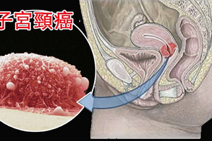 「子宮頸癌」有救了！這個我們「常吃的菜」竟可殺死多它100倍的子宮頸癌細胞！！