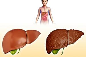 這5個症狀，要注意不然肝癌「附身」，快告訴肝不好的朋友