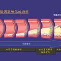 積極治療膽固醇 遠離冠心病及心肌梗塞