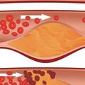 冠心病危害大嗎？引發冠心病的原因有哪些?