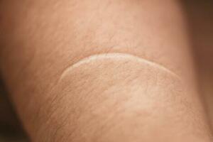 什麼是疤痕體質？怎樣才能預防疤痕？